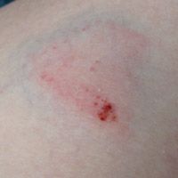Big bruise!