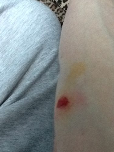 Elbow graze from fall